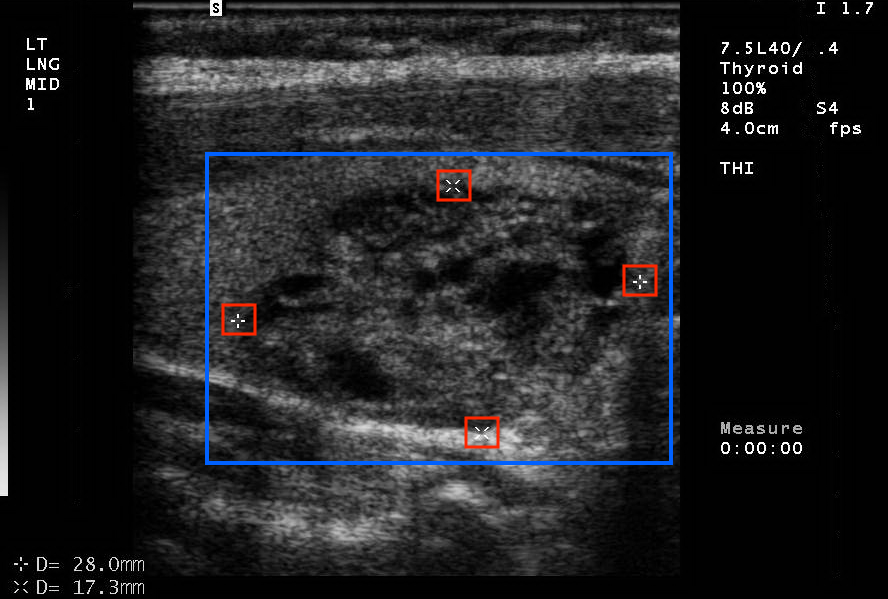 Thyroid ROI