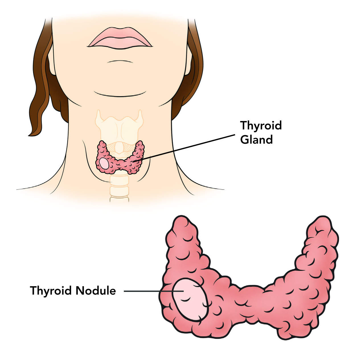 Thyroid nodule