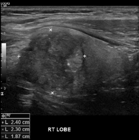 Thyroid Ultrasound