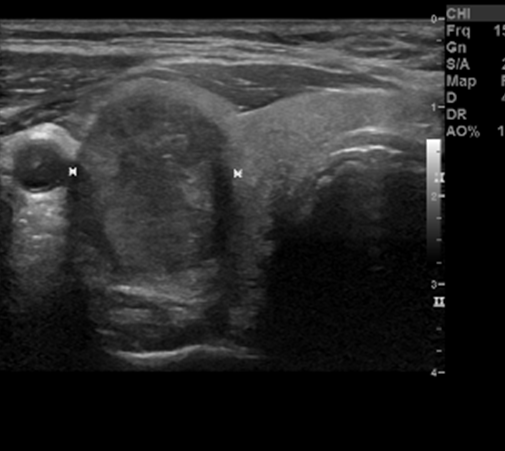 Thyroid Ultrasound